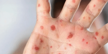 Температура, пухирці, біль у роті: на Київщині шириться небезпечна дитяча інфекція